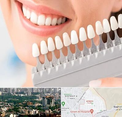 متخصص لمینت دندان در عظیمیه کرج 