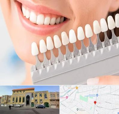 متخصص لمینت دندان در زنبیل آباد قم