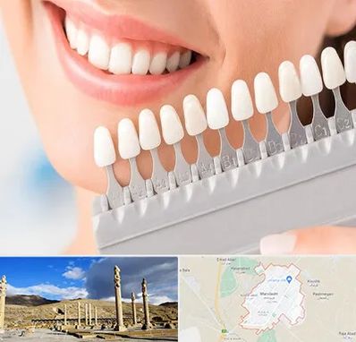 متخصص لمینت دندان در مرودشت
