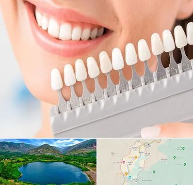 متخصص لمینت دندان در رودبار