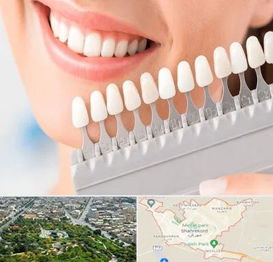 متخصص لمینت دندان در شهرکرد