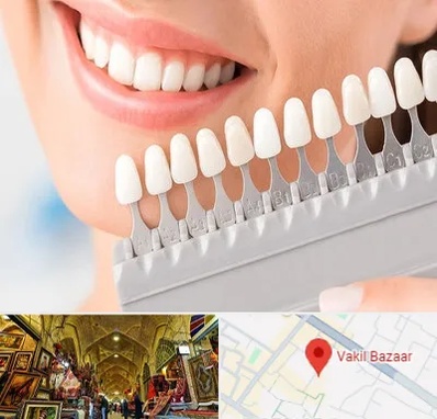 متخصص لمینت دندان در بازار وکیل شیراز