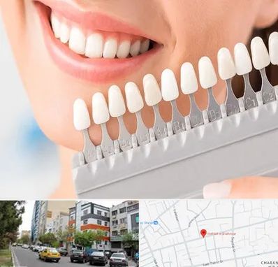 متخصص لمینت دندان در هفده شهریور تبریز