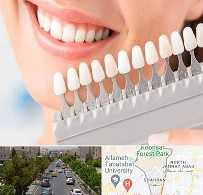 متخصص لمینت دندان در شهران 