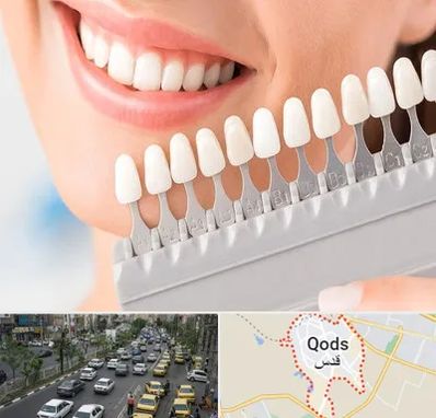 متخصص لمینت دندان در شهر قدس