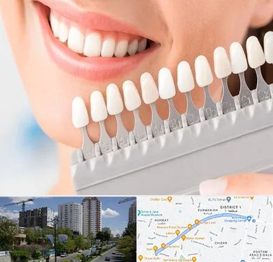 متخصص لمینت دندان در اندرزگو