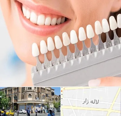متخصص لمینت دندان در لاله زار