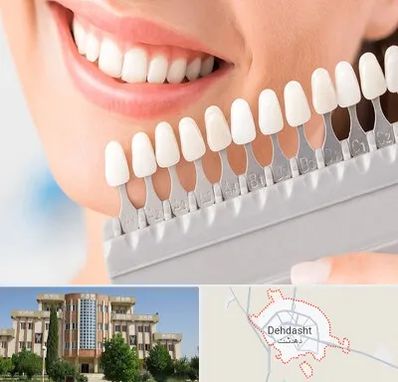 متخصص لمینت دندان در دهدشت