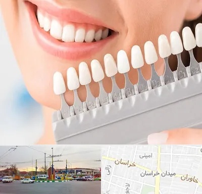 متخصص لمینت دندان در میدان خراسان