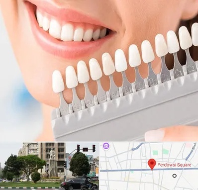 متخصص لمینت دندان در میدان فردوسی تهران
