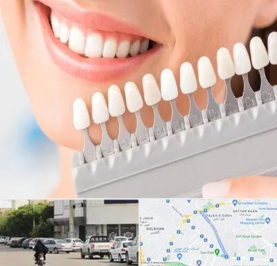 متخصص لمینت دندان در قدوسی شرقی شیراز