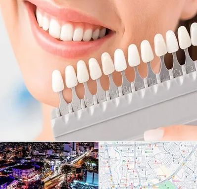 متخصص لمینت دندان در منظریه رشت