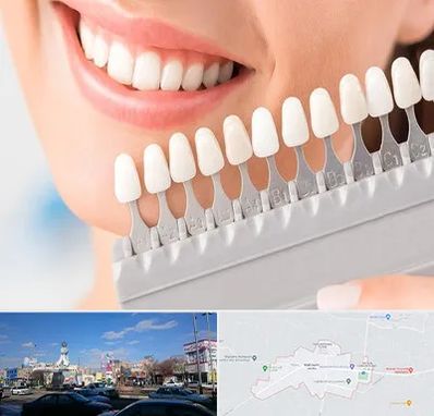 متخصص لمینت دندان در ماهدشت کرج