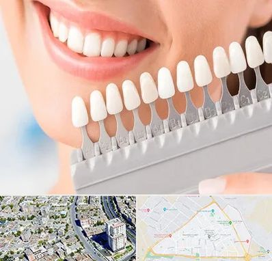 متخصص لمینت دندان در قاسم آباد مشهد