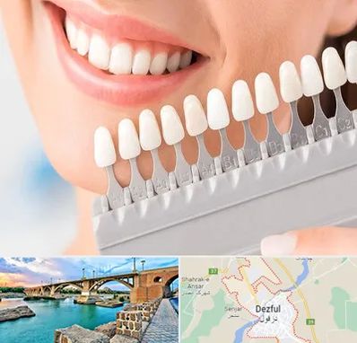 متخصص لمینت دندان در دزفول