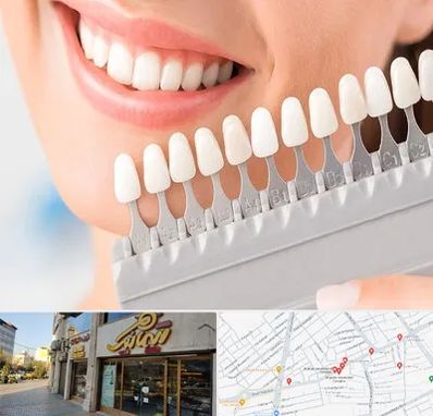 متخصص لمینت دندان در عطاران قم