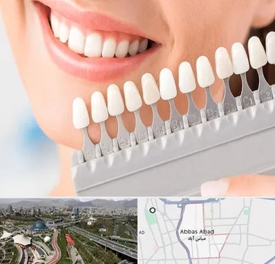 متخصص لمینت دندان در عباس آباد تهران