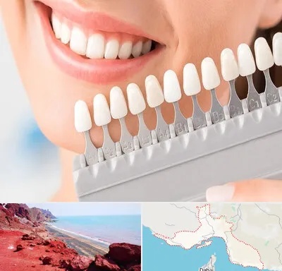 متخصص لمینت دندان در هرمزگان