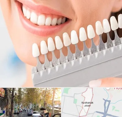 متخصص لمینت دندان در کاشانک