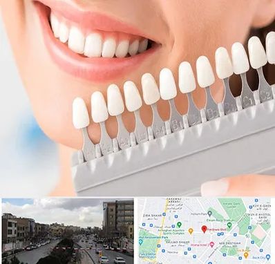 متخصص لمینت دندان در بلوار فردوسی مشهد