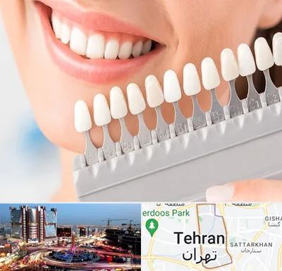 متخصص لمینت دندان در صادقیه 