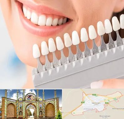 متخصص لمینت دندان در سمنان