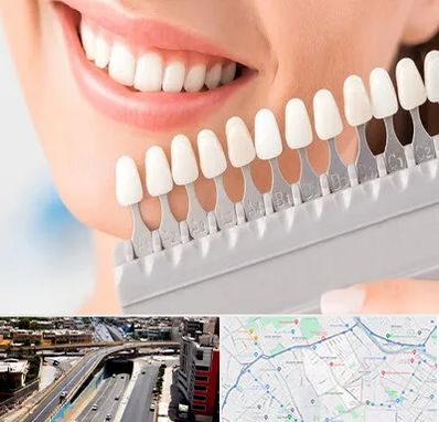 متخصص لمینت دندان در ستارخان شیراز