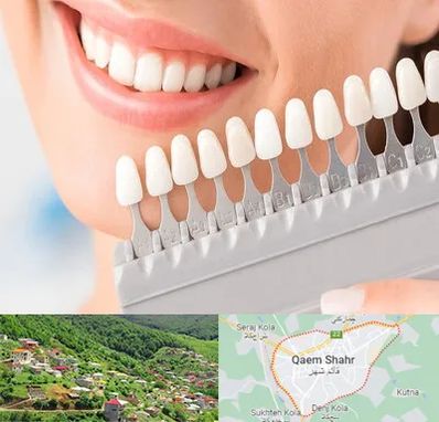 متخصص لمینت دندان در قائم شهر