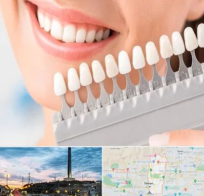 متخصص لمینت دندان در منطقه 2 تهران