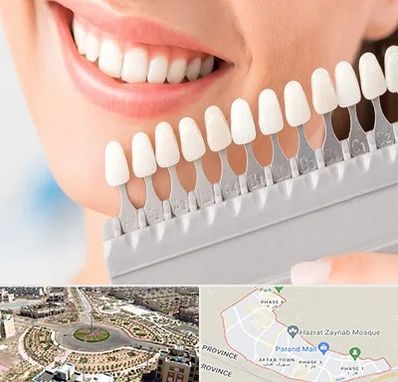 متخصص لمینت دندان در پرند