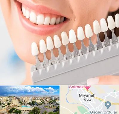متخصص لمینت دندان در میانه
