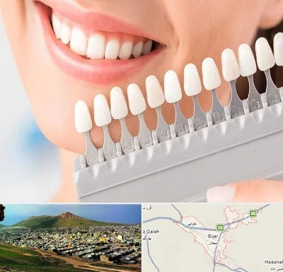 متخصص لمینت دندان در بیجار
