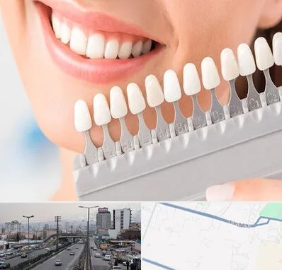 متخصص لمینت دندان در بلوار ارتش