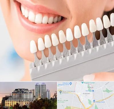 متخصص لمینت دندان در فرشته 