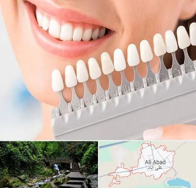 متخصص لمینت دندان در علی آباد کتول