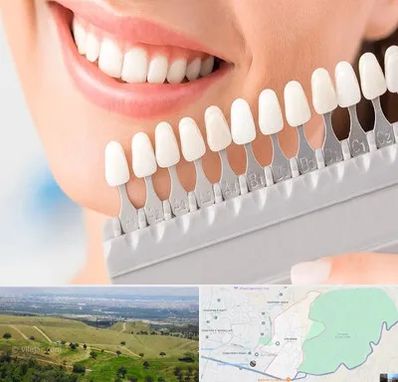 متخصص لمینت دندان در سوهانک