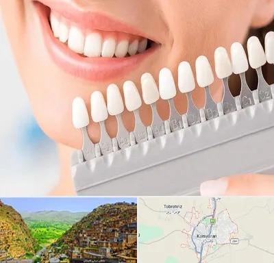 متخصص لمینت دندان در کامیاران