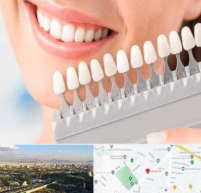 متخصص لمینت دندان در هنگام