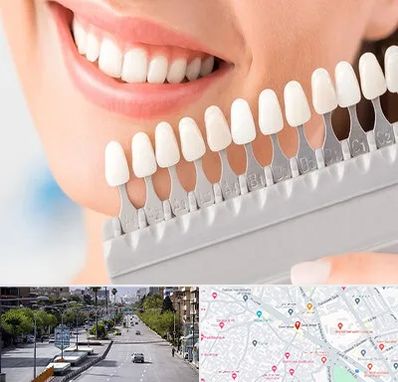 متخصص لمینت دندان در خیابان زند شیراز