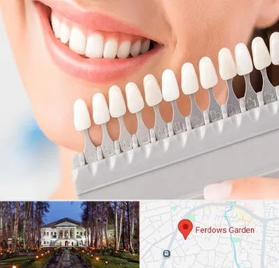 متخصص لمینت دندان در باغ فردوس