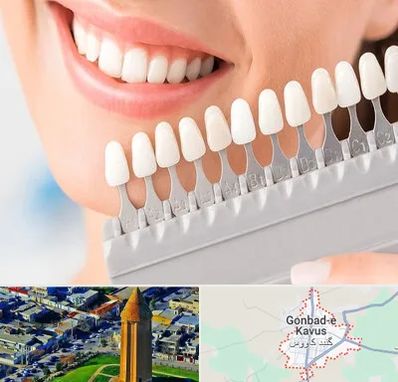 متخصص لمینت دندان در گنبد کاووس