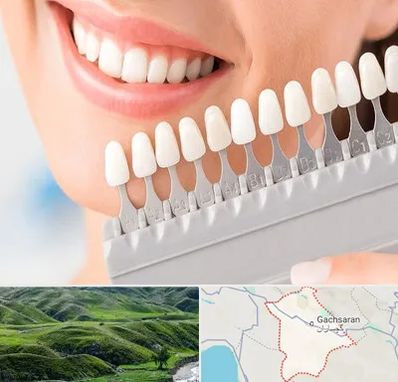 متخصص لمینت دندان در گچساران