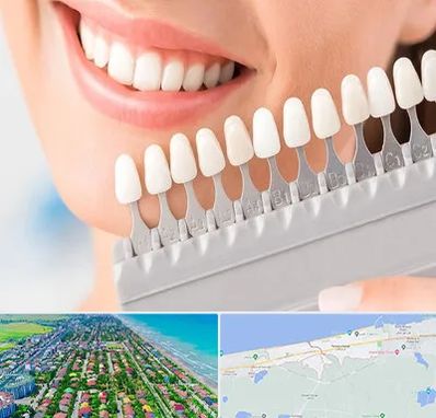 متخصص لمینت دندان در فریدونکنار