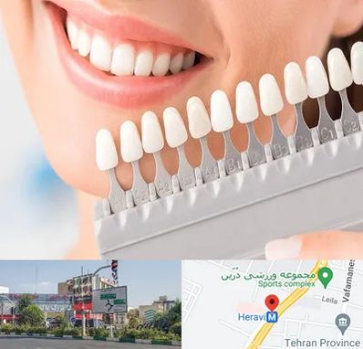 متخصص لمینت دندان در هروی 