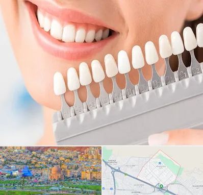 متخصص لمینت دندان در رشدیه تبریز