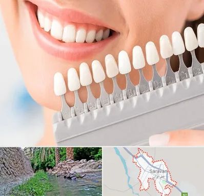 متخصص لمینت دندان در سراوان