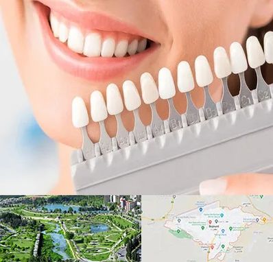 متخصص لمینت دندان در بجنورد