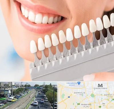 متخصص لمینت دندان در جنوب تهران 