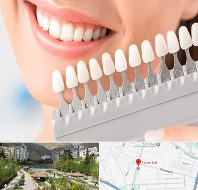 متخصص لمینت دندان در بلوار تعاون