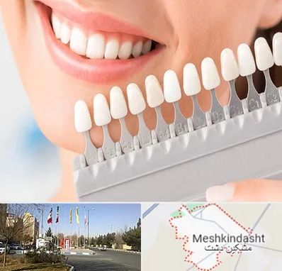 متخصص لمینت دندان در مشکین دشت